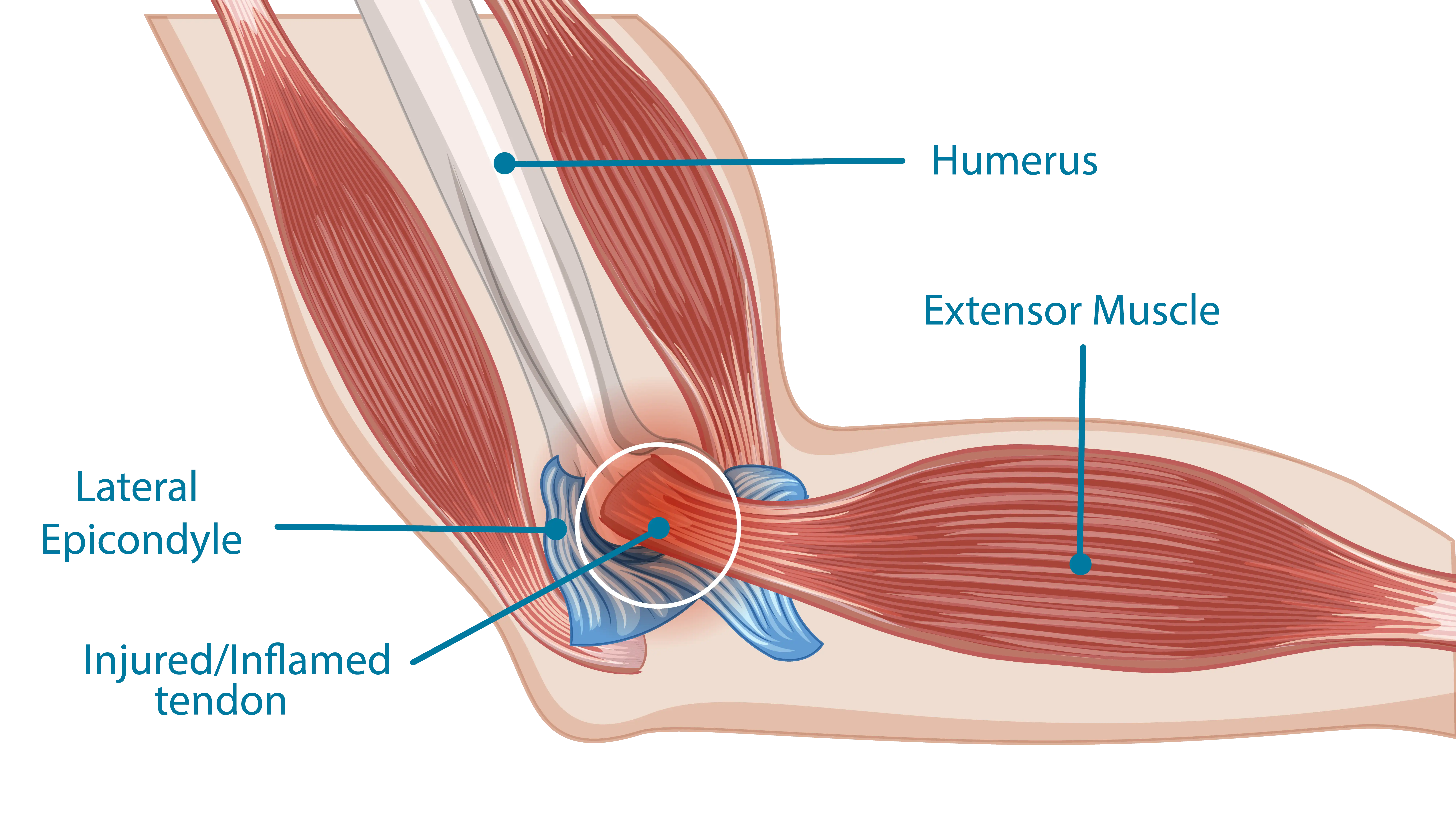 Anatomical graphic of Tennis Elbow