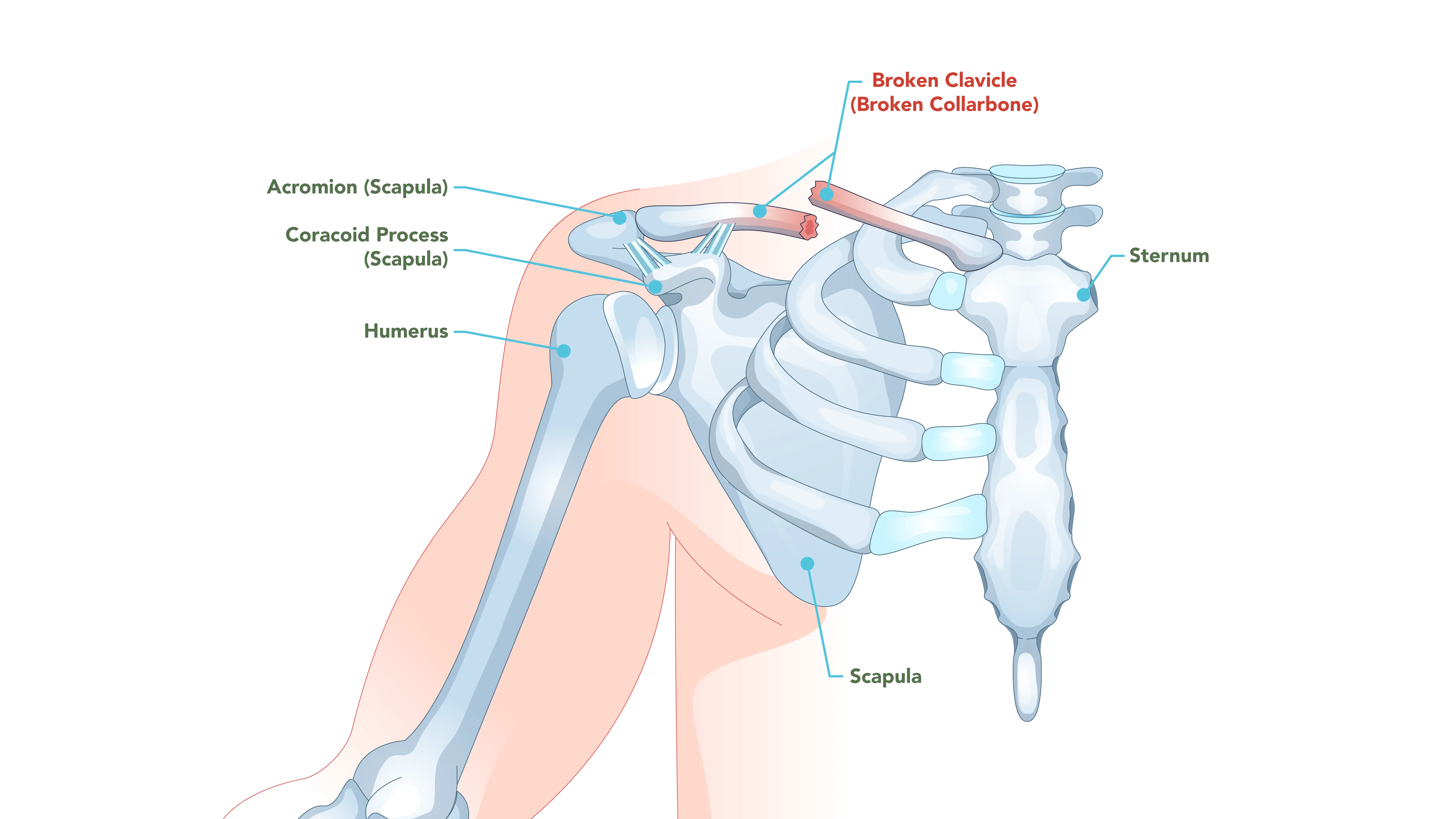 Anatomical Graphic of Broken Clavicle