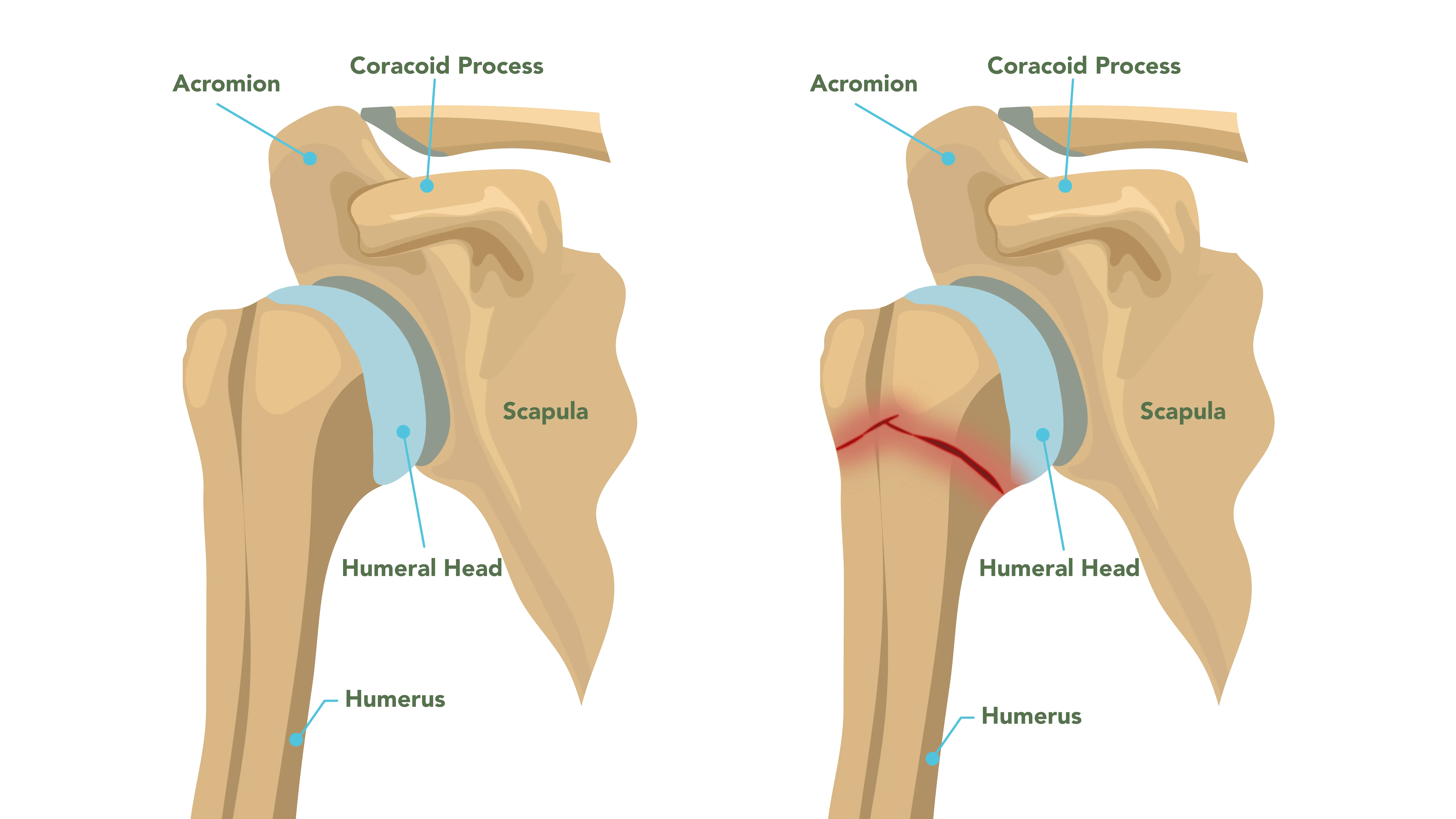Anatomical Graphic of Proximal Humerus Fracture