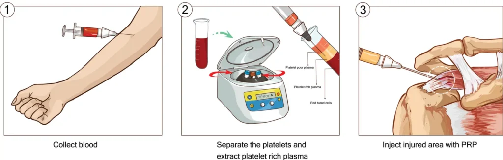 Basic steps for PRP in the shoulder