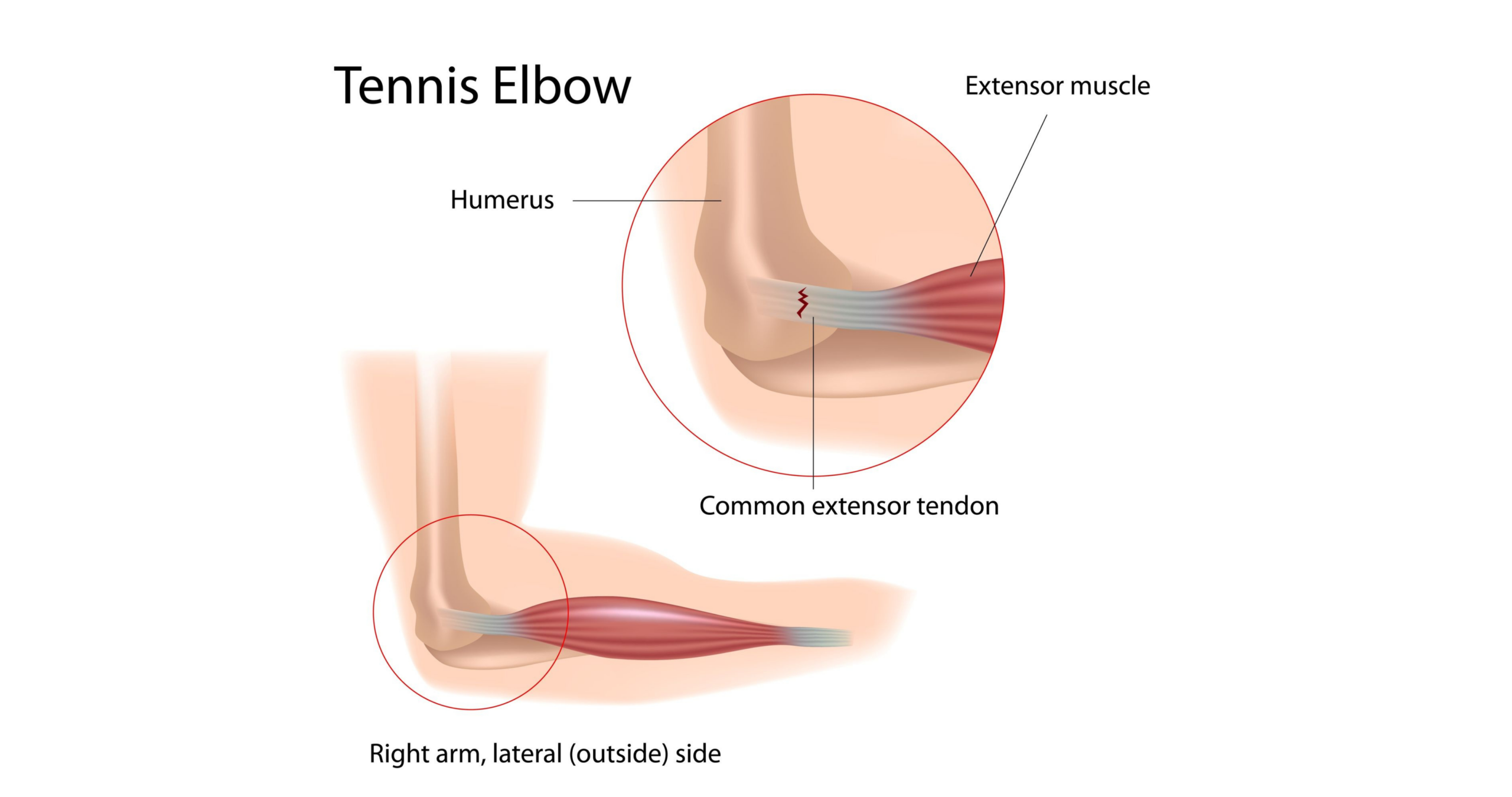 Tennis elbow anatomy Tennis elbow anatomy