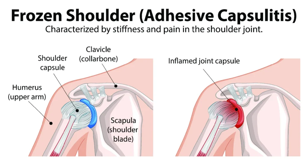 frozen shoulder diagram patient suffering from frozen shoulder