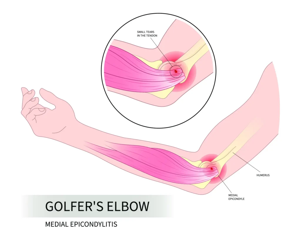 golfers elbow diagram A diagram of Golfer’s elbow, also known as medial epicondylitis.