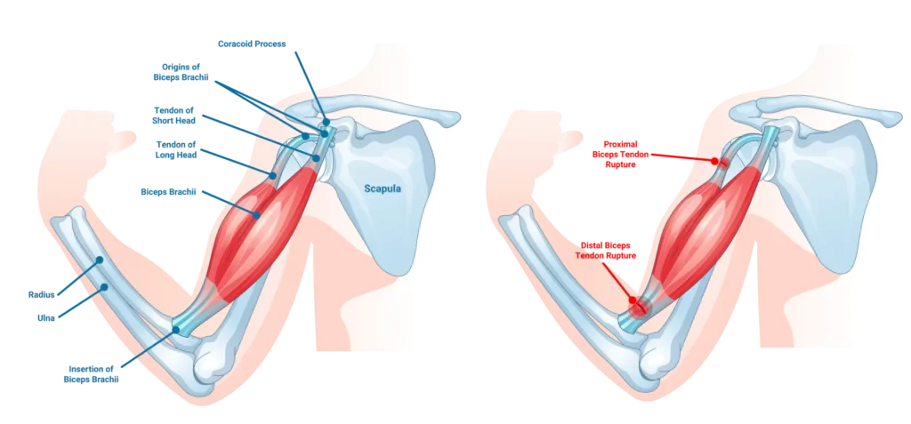 Biceps tendon rupture Biceps tendon tear at the shoulder and elbow