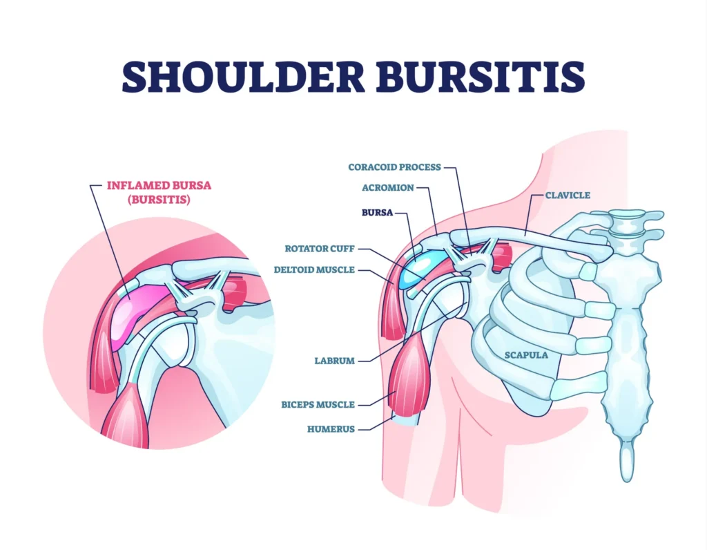 shoulder bursitis shoulder bursitis anatomical diagram