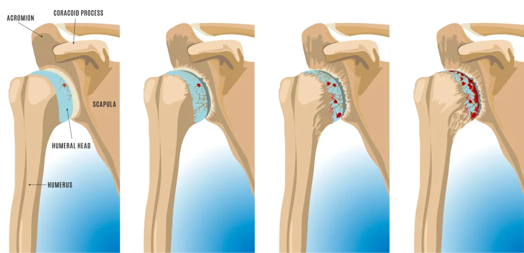 Illustration of shoulder arthritis.