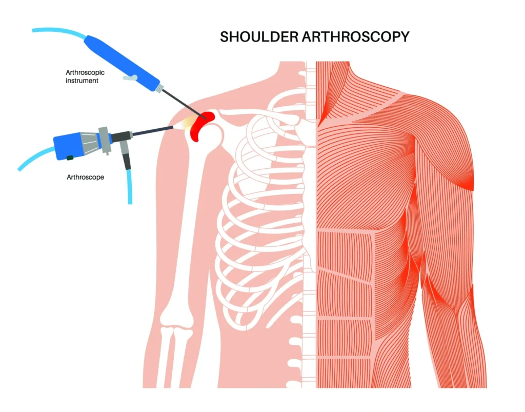 shoulder arthroscopy diagram.