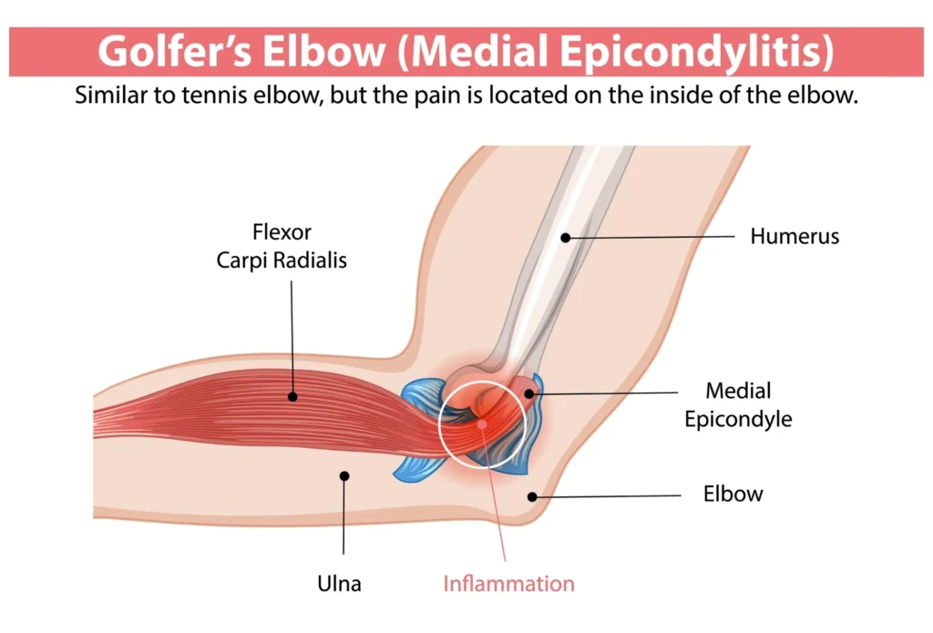 Golfer's elbow diagram