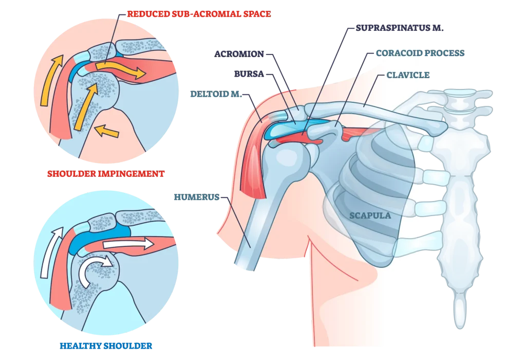 Diagram of shoulder impingement