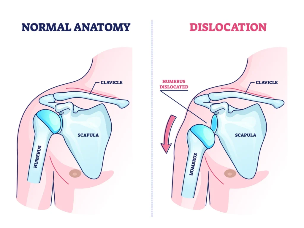 Side-by-side diagram of normal shoulder anatomy and a dislocated shoulder, with the humerus pushed out of the socket